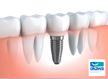 Implantes Clínica Odontológica Okawa